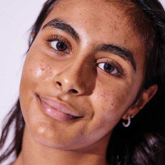 What is blemish-prone skin?