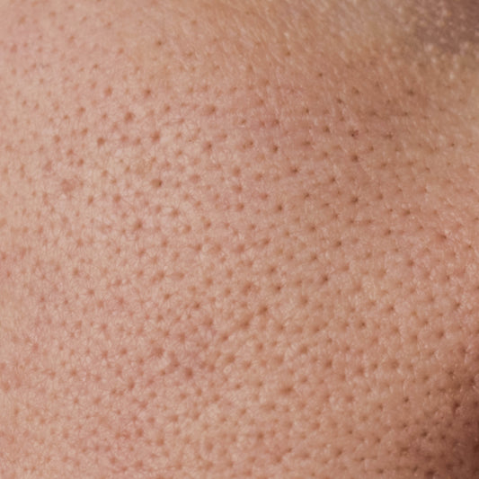 What are clogged pores?