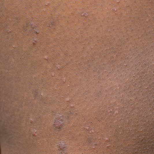 How do I help my eczema?