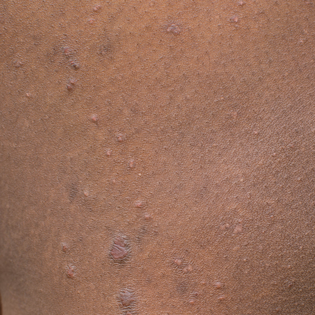 How do I help my eczema?