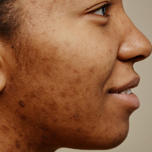 What is hyperpigmentation?