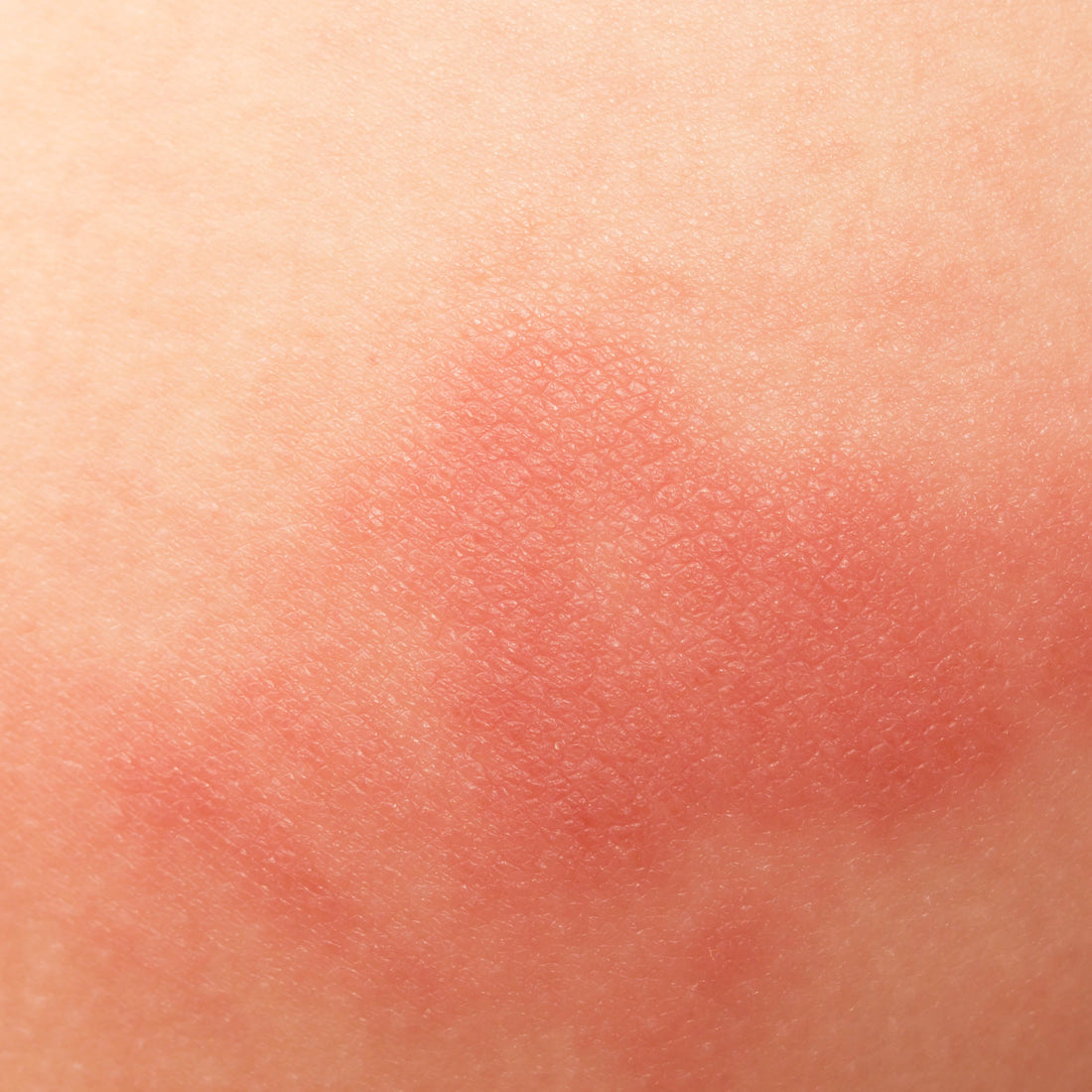 How do I reduce skin redness?