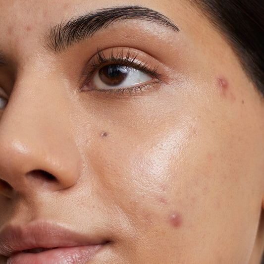 Top tips for spot and acne scars