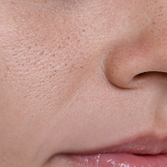 Should I squeeze spots and blackheads?